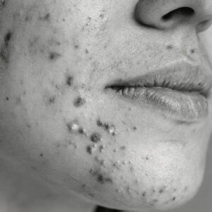 Acne-Prone Skin