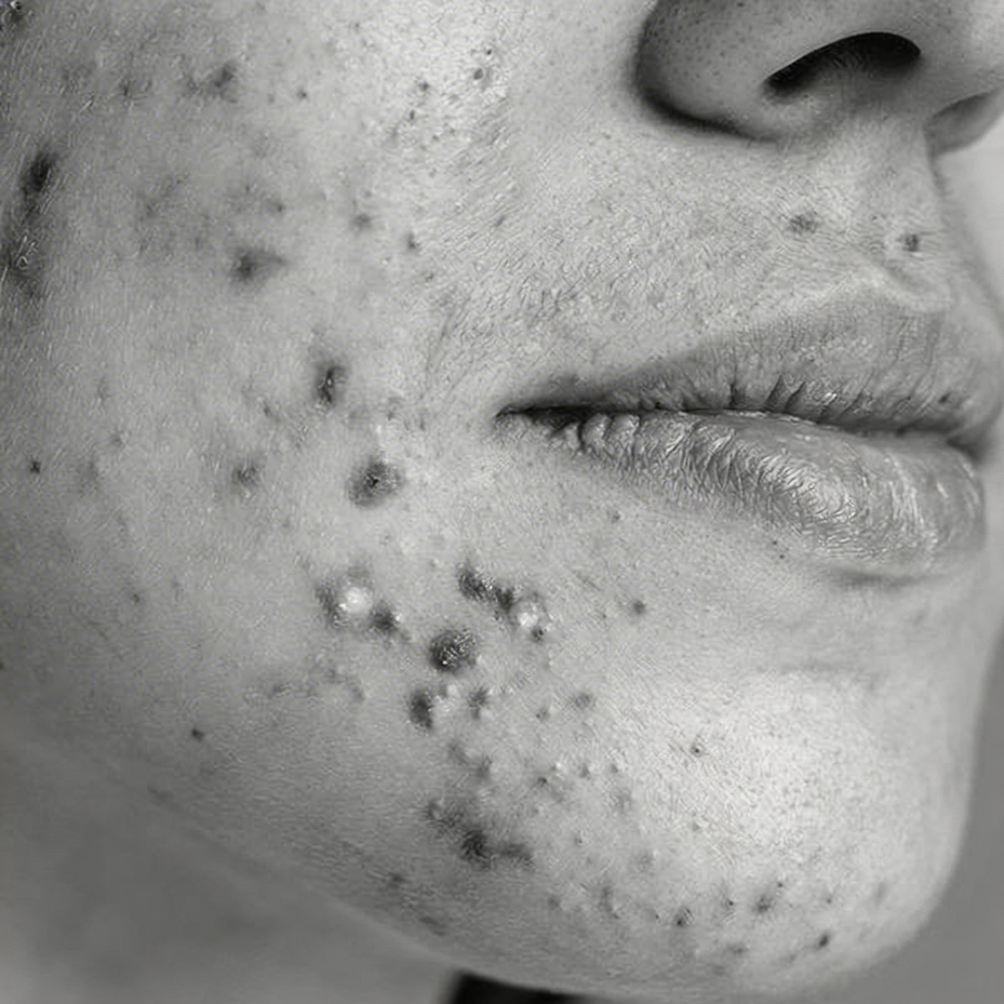 Acne-Prone Skin