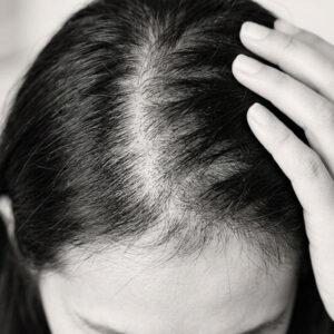 Hair Thinning & Hair Loss