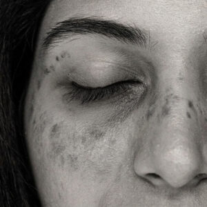 Pigmentation & Dark Spots